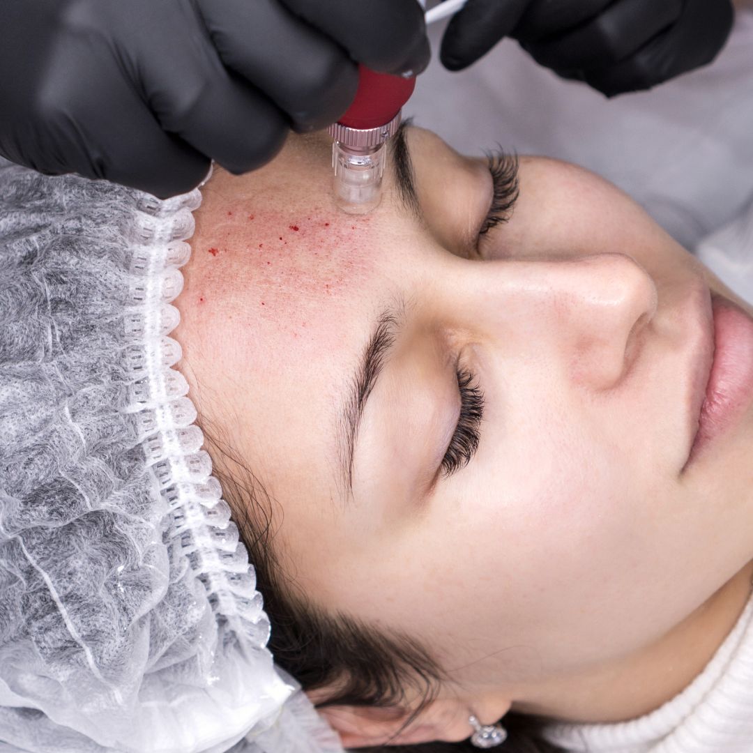 Skin Needling